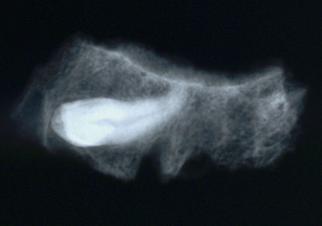 Fig. 2: Skeleton 083. Impacted left maxillary canine (radiograph) (Bourbou 2006–2007)