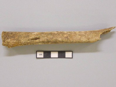 Fig. 4: Skeleton 088. Osteomyelitis of the right tibial shaft.